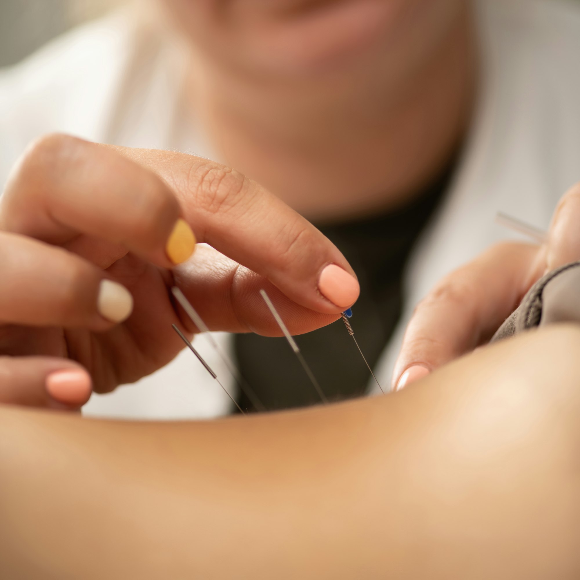 Acupuncture for lower back pain