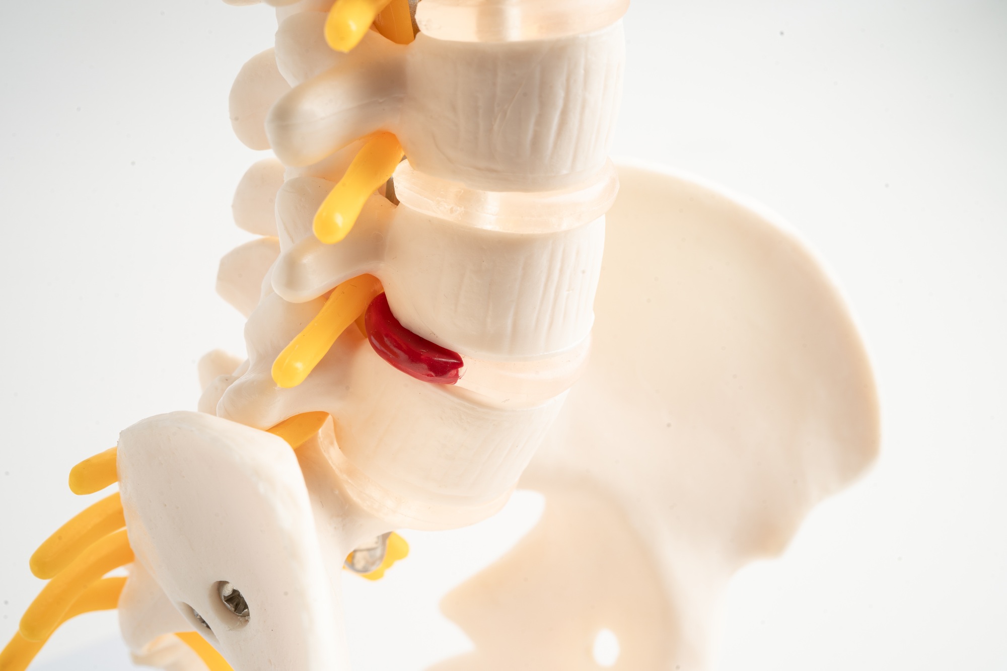 Lumbar spine displaced herniated disc fragment, spinal nerve and bone.